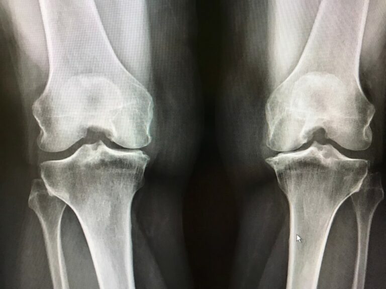 New Treatment for CRPS - Atlas Pain Specialists