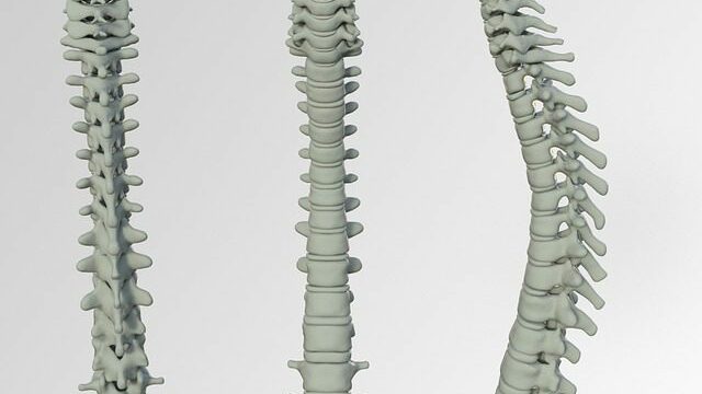 Spinal column for post Treatment for disc extrusion