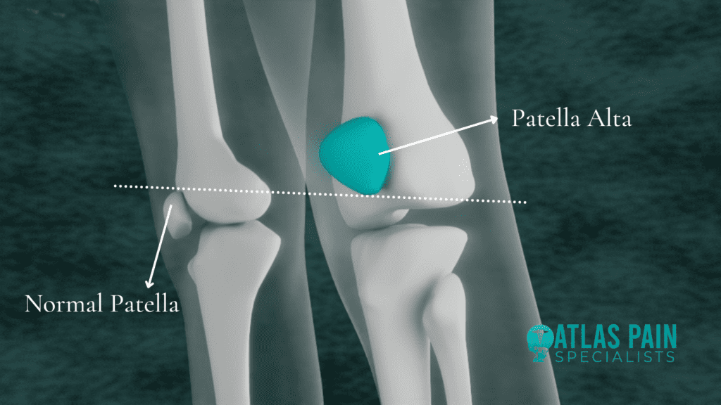 illustration showing difference in positioning of the patella alta and the normal patella in the knee