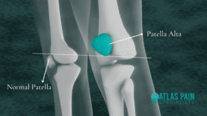 Possible Causes And Treatment Of Patella Alta - Atlas Pain Specialists