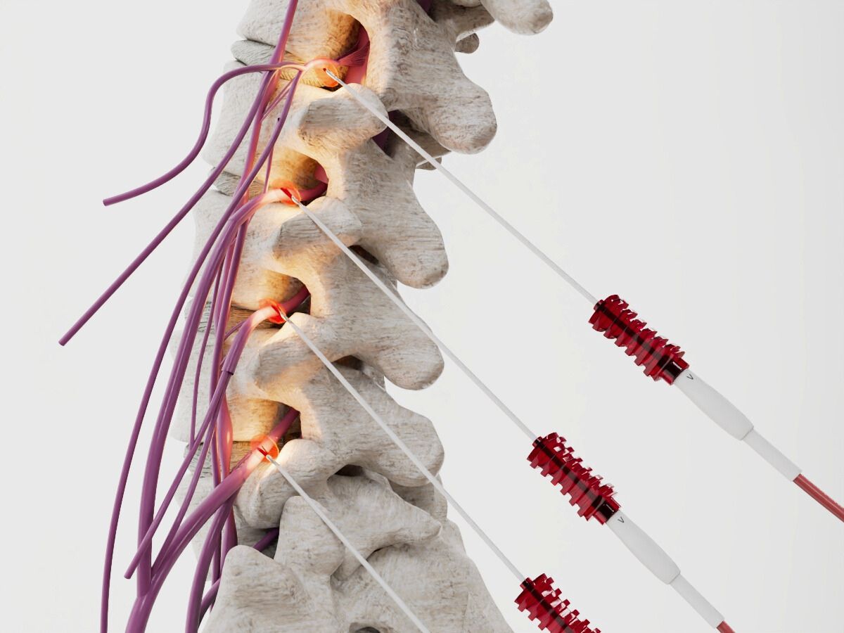 Radiofrequency Ablation